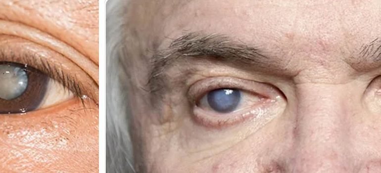 Cataract Surgery in Zirakpur