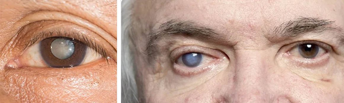 Cataract Surgery in Zirakpur