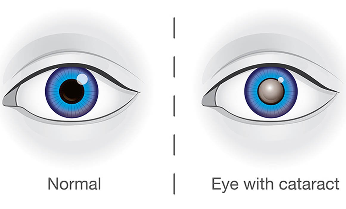 Cataract Surgery in Zirakpur