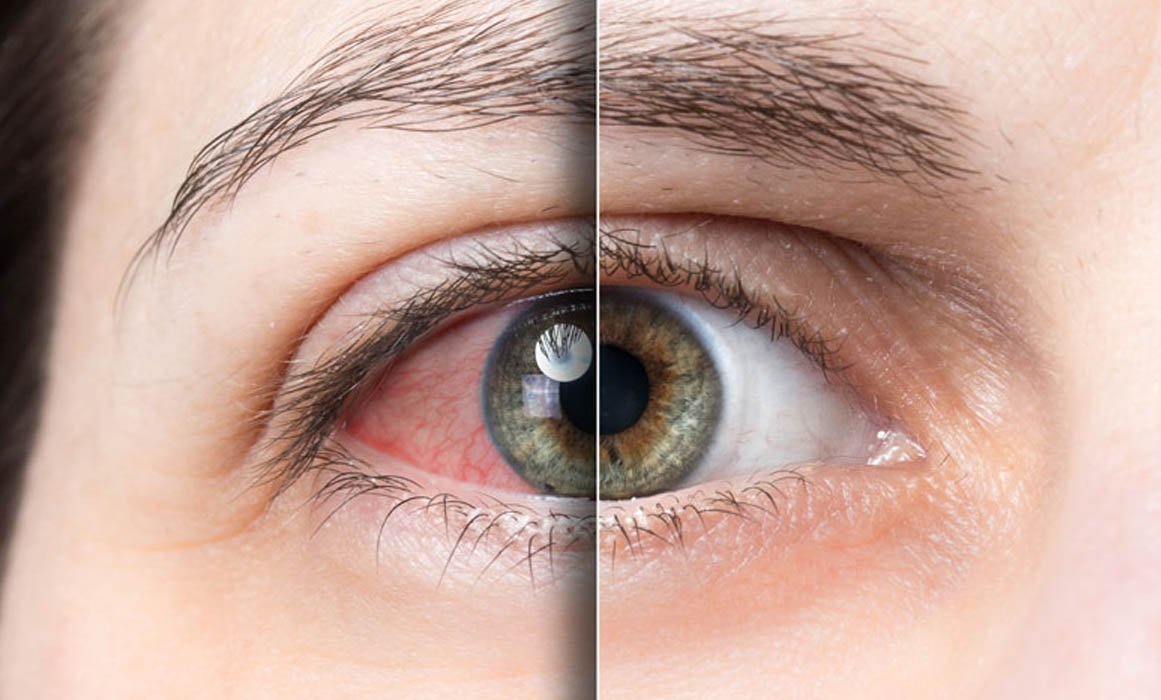 Cataract Surgery in Zirakpur