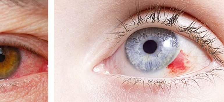 Cataract Surgery in Zirakpur