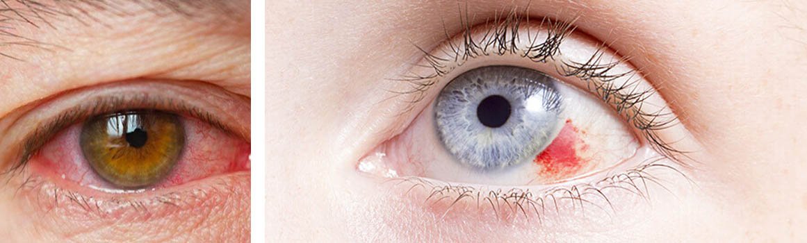 Cataract Surgery in Zirakpur