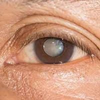 Cataract-&-Corneal-Disease Cataract & Corneal Disease